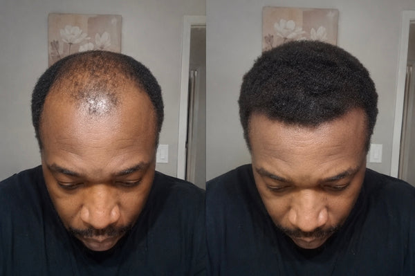 5 Months In — Hairline & crown fully recovered