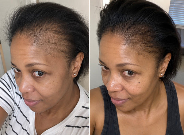 4 Months In — Full crown restored