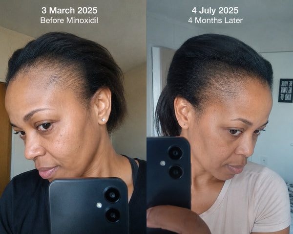 4 Months In — Thicker, fuller hair returning